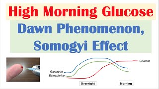 High Early Morning Glucose  Dawn Phenomenon amp Somogyi Effect [upl. by Tilagram392]