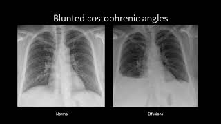 Pleural Effusions [upl. by Reggy]