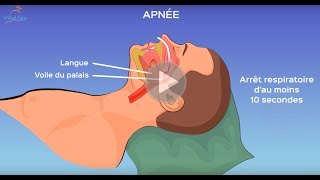 L’apnée du sommeil qu’estce que c’est [upl. by Dix]