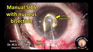 manual SICS cataract surgery with nucleus bisection [upl. by Aribold]