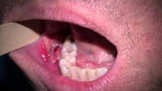 How to Get Rid of Canker Sores According to Science [upl. by Tica584]