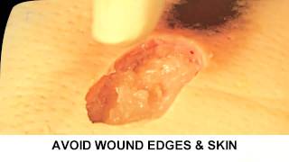 Enzymatic Debridement Demonstration Understand Wound Care [upl. by Tawney581]