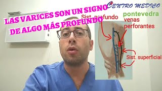 VARICES e Insuficiencia venosa CÓMO TRATARLAS y prevenirlas [upl. by Agate901]