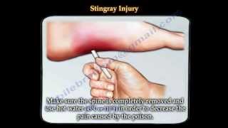 Stingray fish injury  Everything You Need To Know  Dr Nabil Ebraheim [upl. by Yeslaehc]