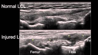 Sonographic Examination of Knee Ligaments [upl. by Ennairoc]