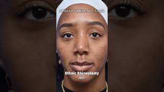 Ethnic Rhinoplasty [upl. by Colman728]