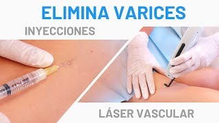 Varices en las Piernas Tratamiento Láser Vascular  Escleroterapia [upl. by Mylan125]