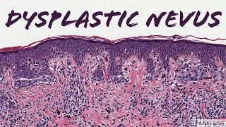 Dysplastic Nevus 5Minute Pathology Pearls [upl. by Zemaj]