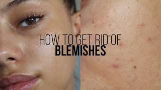 HOW TO GET RID OF BLEMISHES IN 3 DAYS  Jessicvpimentel [upl. by Ag870]