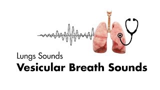 The Lung Sounds of Pneumonia [upl. by Ithaman529]