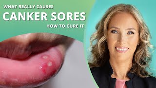 Mouth Ulcers Canker Sores in Children  Causes Symptoms amp Treatment [upl. by Warford]