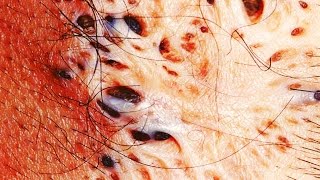 Spreading Blackheads amp Trypophobia [upl. by Arakihc321]