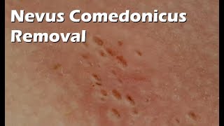 Nevus Comedonicus Removal  9 minutes worth [upl. by Etheline]