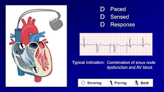 Pacemaker Modes and Settings [upl. by Aramen725]