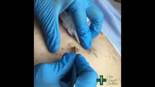 Removal of Seborrheic Keratosis [upl. by Kathy510]