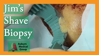 Jims Forehead Shave Biopsy for Basal Cell Carcinoma  Auburn Medical Group [upl. by Aliehs456]