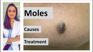 How to remove a mole  Mole causes amp removal  home remedy  Dermatologist  Dr Aanchal Panth [upl. by Manwell]