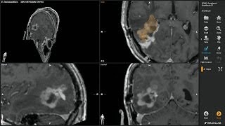 Smartbrush—Volumetric Tumor Outlining by Brainlab [upl. by Manheim248]