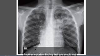 Tuberculosis Active TB  Chest x ray [upl. by Margreta]