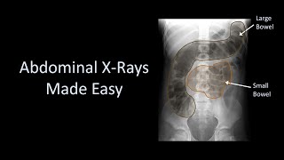 Abdominal XRays Made Easy [upl. by Ayikan705]