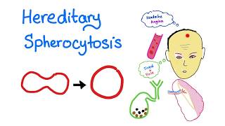 Hereditary Spherocytosis HS  Red Blood Cell Disorders  Hematology [upl. by Artimas]