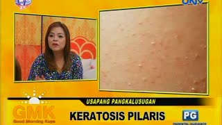 Keratosis Pilaris chicken skin [upl. by Luise]