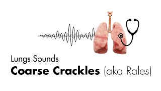 Bronchitis Symptoms Causes Treatments  Dr MyHuyen Tran [upl. by Zahavi2]