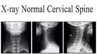 Xray Normal cervical spine anatomy [upl. by Agatha]