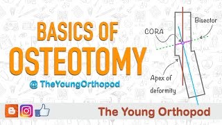 Osteochondroma Exostosis Bone Pathology Basics [upl. by Heymann825]