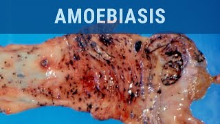 Amoebiasis  Pathology mini tutorial [upl. by Ymmit]