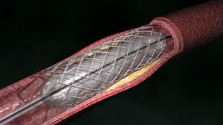 Coronary Artery Angioplasty  Radial Access [upl. by Avraham311]