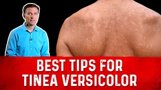 Best Tips for Tinea Versicolor Treatment Skin Fungus – Dr Berg [upl. by Suriaj]