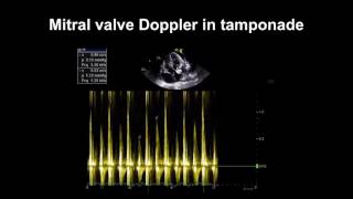 Echocardiography Essentials Detecting pericardial effusions [upl. by Nodnrb]