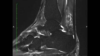 MRI ankle Split Peroneus Brevis Tear [upl. by Ubana]