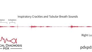 The Lung Sounds of Pneumonia [upl. by Maite]