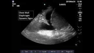 Lung and Pleural Ultrasound Interpretation [upl. by Ynagoham630]