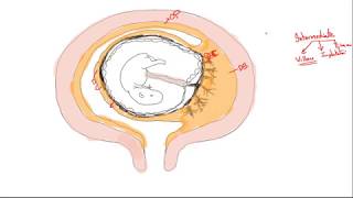 Gestational trophoblastic disease part 1 Introduction [upl. by Neelak648]