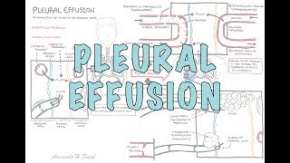 Pleural Effusion DETAILED  pathophysiology signs and symptoms treatment [upl. by Rudman516]