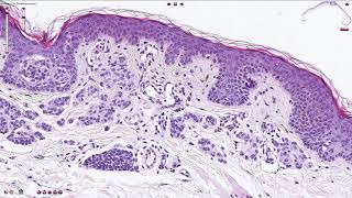 Compound Melanocytic Nevus  Histopathology [upl. by Gerbold]