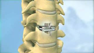 Herniated Disc Causes Signs and Symptoms Diagnosis and Treatment [upl. by Eilitan]