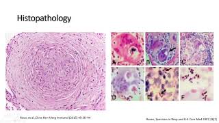 Sarcoidosis [upl. by Godding]