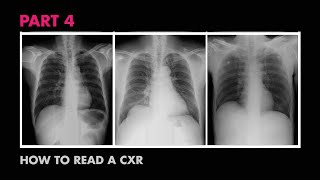 Assessment of CXR Positioning amp Views  How to Read a Chest XRay Part 4  MEDZCOOL [upl. by Filippo]