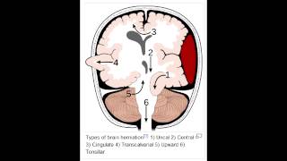 Herniation Syndromes  Cingulate subfalcine Transtentorial Uncal amp Cerebellar Tonsillar [upl. by Aneehsram992]