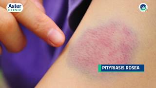 Dr Srinivasa Munivenkatappa talks about Pityriasis Rosea [upl. by Namyw745]