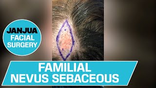 FAMILIAL NEVUS SEBACEOUS  DR TANVEER JANJUA  NEW JERSEY [upl. by Aitret908]