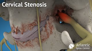 Cervical stenosis [upl. by Aitat]