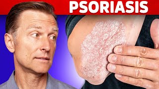 Psoriasis Treatment – The Best 3 Remedies for Psoriasis – DrBerg [upl. by Isobel822]