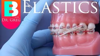 BRACES EXPLAINED Elastics  Rubber Bands [upl. by Ivey]