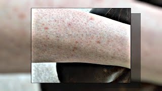 No You Dont Have quotChicken Skinquot Its Called KP Keratosis Pilaris amp Heres How To Get Rid Of It [upl. by Iphigeniah170]