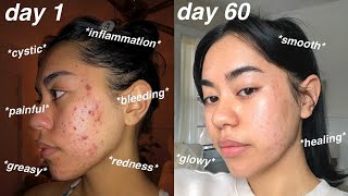 I CLEARED MY ACNE 60 days using Differin Gel Adapalene 01  pictures [upl. by Smalley]